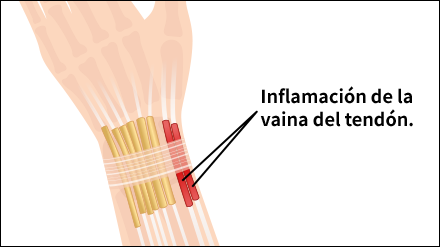 Gamer’s Thumb, Gamer’s Wrist or De Quervain’s Tenosynovitis