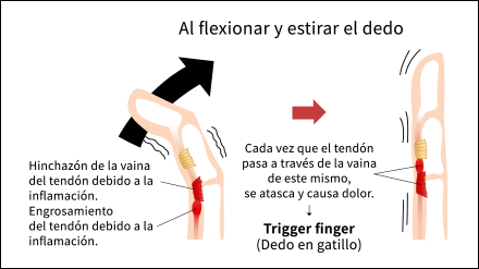 Trigger Finger / Thumb