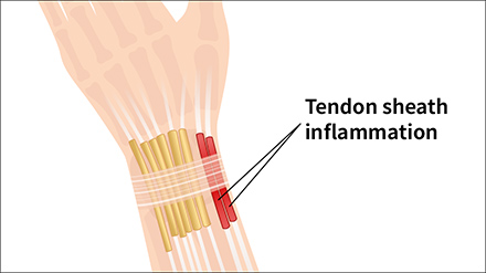 Gamer’s Thumb, Gamer’s Wrist or De Quervain’s Tenosynovitis