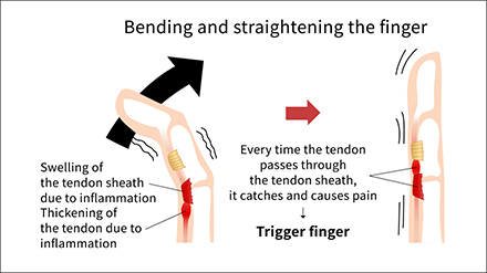 Trigger Finger / Thumb