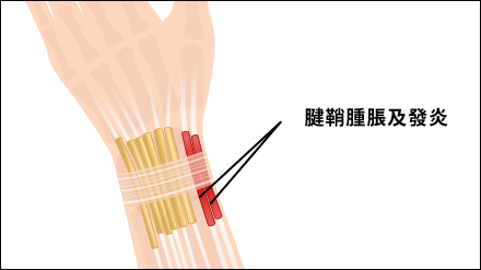 Gamer’s Thumb, Gamer’s Wrist or De Quervain’s Tenosynovitis