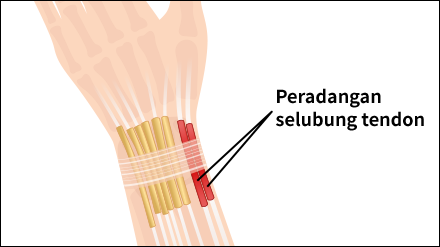 Gamer’s Thumb, Gamer’s Wrist or De Quervain’s Tenosynovitis