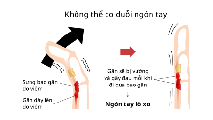 Gamer’s Thumb, Gamer’s Wrist or De Quervain’s Tenosynovitis